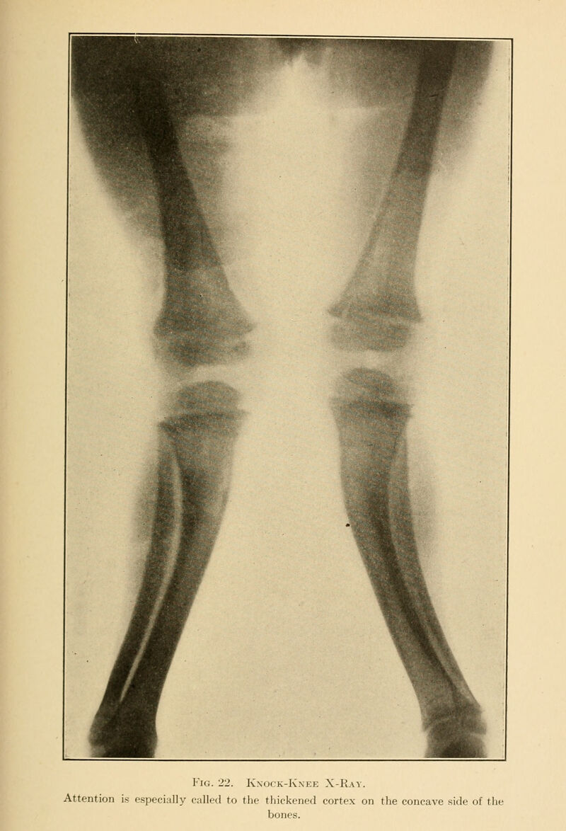 Fig. 22. K\ock-Knee X-Ray. Attention is especially called to the thickened cortex on the concave side of tli bones.