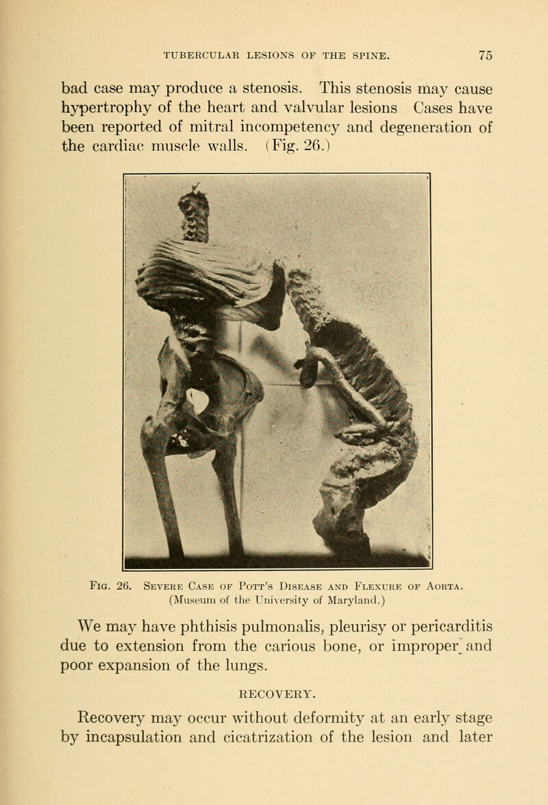 bad case may produce a stenosis. This stenosis may cause hypertrophy of the heart and valvular lesions Cases have been reported of mitral incompetency and degeneration of the cardiac muscle walls. (Fig. 26.) Fig. 26. Severe Case op Pott's Disease and Flexure of Aorta. (Museum of the University of Maryland.) We may have phthisis pulmonalis, pleurisy or pericarditis due to extension from the carious bone, or improper and poor expansion of the lungs. RECOVERY. Recovery may occur without deformity at an early stage by incapsulation and cicatrization of the lesion and later