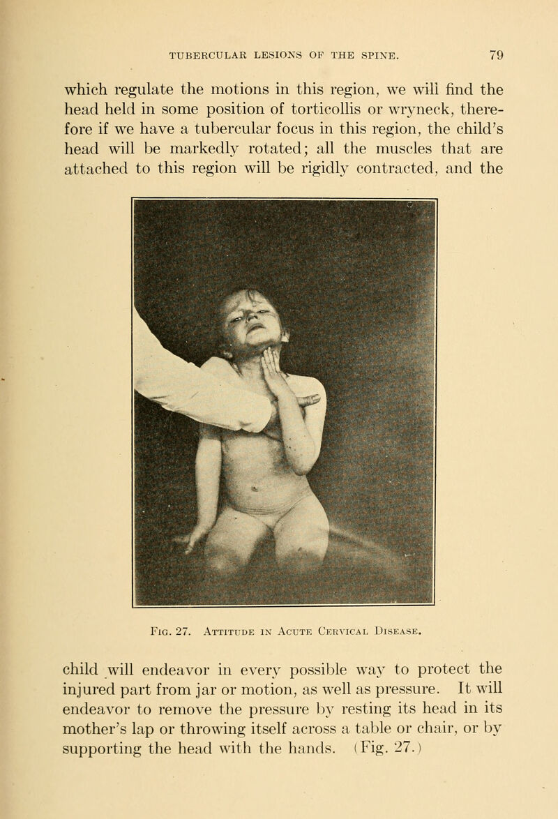 which regulate the motions in this region, we will find the head held in some position of torticollis or wryneck, there- fore if we have a tubercular focus in this region, the child's head will be markedly rotated; all the muscles that are attached to this region will be rigidly contracted, and the Fig. 27. Attitude in Acute Cervical Disease. child will endeavor in every possible way to protect the injured part from jar or motion, as well as pressure. It will endeavor to remove the pressure by resting its head in its mother's lap or throwing itself across a table or chair, or by supporting the head with the hands. (Fig. 27.)