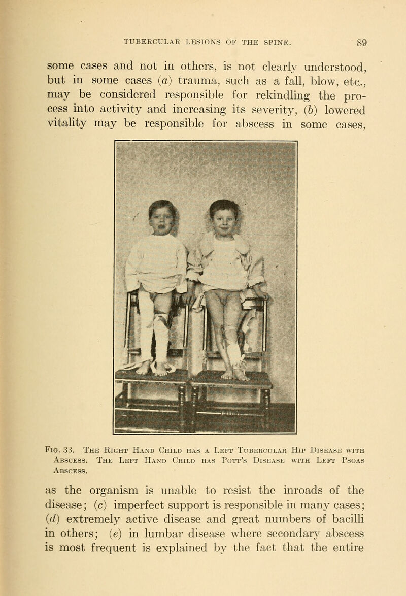 some cases and not in others, is not clearly understood, but in some cases (a) trauma, such as a fall, blow, etc., may be considered responsible for rekindhng the pro- cess into activity and increasing its severity, (6) lowered vitality may be responsible for abscess in some cases, Fig. 33. The Right Hand Child has a Left Tubercular Hip Disease with Abscess. The Left Haxd Child has Pott's Disease with Left Psoas Abscess. as the organism is unable to resist the inroads of the disease; (c) imperfect support is responsible in many cases; {d) extremely active disease and great numbers of bacilli in others; (e) in lumbar disease where secondary abscess is most frequent is explained by the fact that the entire