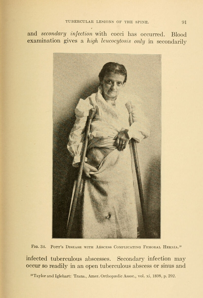 and secondary infection with cocci has occurred. Blood examination gives a high leucocytosis only in secondarily Fig. 34. Pott's Disease with Abscess Complicating Femoral Hernia.'* infected tuberculous abscesses. Secondary infection may occur so readily in an open tuberculous abscess or sinus and Taylor and Iglehart: Trans., Amer. Orthopaedic Assoc, vol. xi, 1898, p. 292.