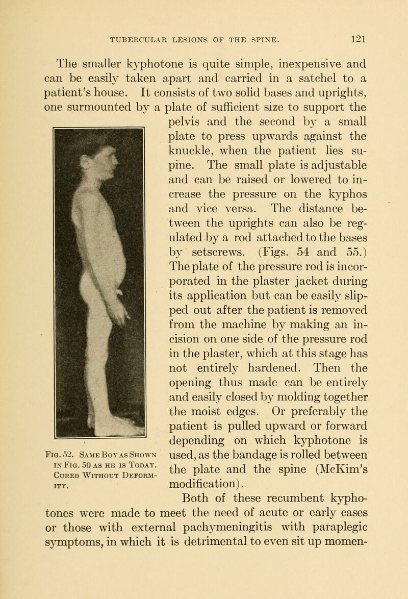 The smaller kyphotone is quite simple, inexpensive and can be easily taken apart and carried in a satchel to a patient's house. It consists of two solid bases and uprights, one surmounted by a plate of sufficient size to support the pelvis and the second by a small plate to press upwards against the knuckle, when the patient lies su- pine. The small plate is adjustable and can be raised or lowered to in- crease the pressure on the kyphos and vice versa. The distance be- tween the uprights can also be reg- ulated by a rod attached to the bases by setscrews. (Figs. 54 and 55.) The plate of the pressure rod is incor- porated in the plaster jacket during its application but can be easily slip- ped out after the patient is removed from the machine by making an in- cision on one side of the pressure rod in the plaster, which at this stage has not entirely hardened. Then the opening thus made can be entirely and easily closed by molding together the moist edges. Or preferably the patient is pulled upward or forward depending on which kyphotone is used, as the bandage is rolled between the plate and the spine (McKim's modification). Both of these recumbent kypho- tones were made to meet the need of acute or early cases or those with external pachymeningitis with paraplegic symptoms, in which it is detrimental to even sit up momen- FiG. 52. Same Boy as Shown IN Fig. 50 as he is Today. Cured Without Deform- ity.