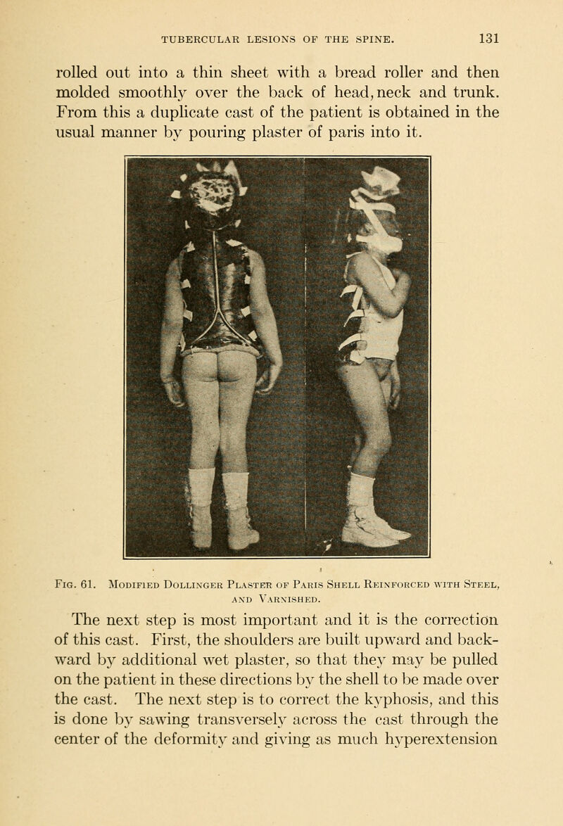 rolled out into a thin sheet with a bread roller and then molded smoothly over the back of head, neck and trunk. From this a duplicate cast of the patient is obtained in the usual manner by pouring plaster of paris into it. Fig. 61. Modified Dollinger Plaster op Paris Shell Reinforced with Steel, AND Varnished. The next step is most important and it is the correction of this cast. First, the shoulders are built upward and back- ward by additional wet plaster, so that they may be pulled on the patient in these directions by the shell to be made over the cast. The next step is to correct the kyphosis, and this is done by sawing transversely across the cast through the center of the deformity and giving as much hyperextension