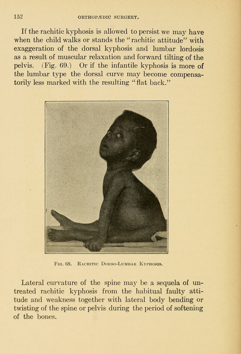 If the rachitic kyphosis is allowed to persist we may have when the child walks or stands the rachitic attitude with exaggeration of the dorsal kyphosis and lumbar lordosis as a result of muscular relaxation and forward tilting of the pelvis. (Fig. 69.) Or if the infantile kyphosis is more of the lumbar type the dorsal curve may become compensa- torily less marked with the resulting flat back. Fig. 68. Rachitic Uorso-Lumbar Kyphosis. Lateral curvature of the spine may be a sequela of un- treated rachitic kyphosis from the habitual faulty atti- tude and weakness together with lateral body bending or twisting of the spine or pelvis during the period of softening of the bones.