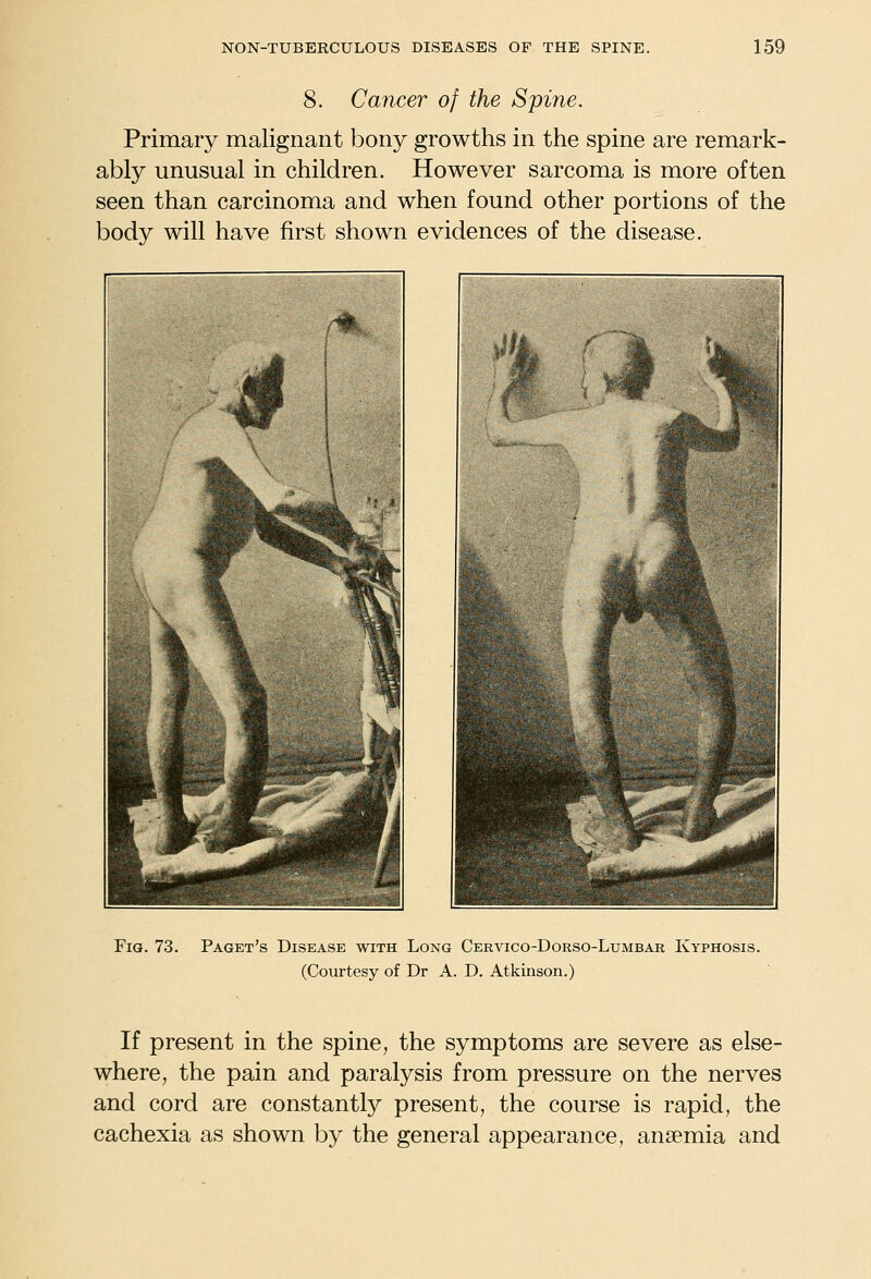 8. Cancer of the Spine. Primary malignant bony growths in the spine are remark- ably unusual in children. However sarcoma is more often seen than carcinoma and when found other portions of the body will have first shown evidences of the disease. Fig. 73. Paget's Disease with Long Cervico-Dorso-Lumbar Kyphosis. (Courtesy of Dr A. D. Atkinson.) If present in the spine^ the symptoms are severe as else- where, the pain and paralysis from pressure on the nerves and cord are constantly present, the course is rapid, the cachexia as shown by the general appearance, anaemia and