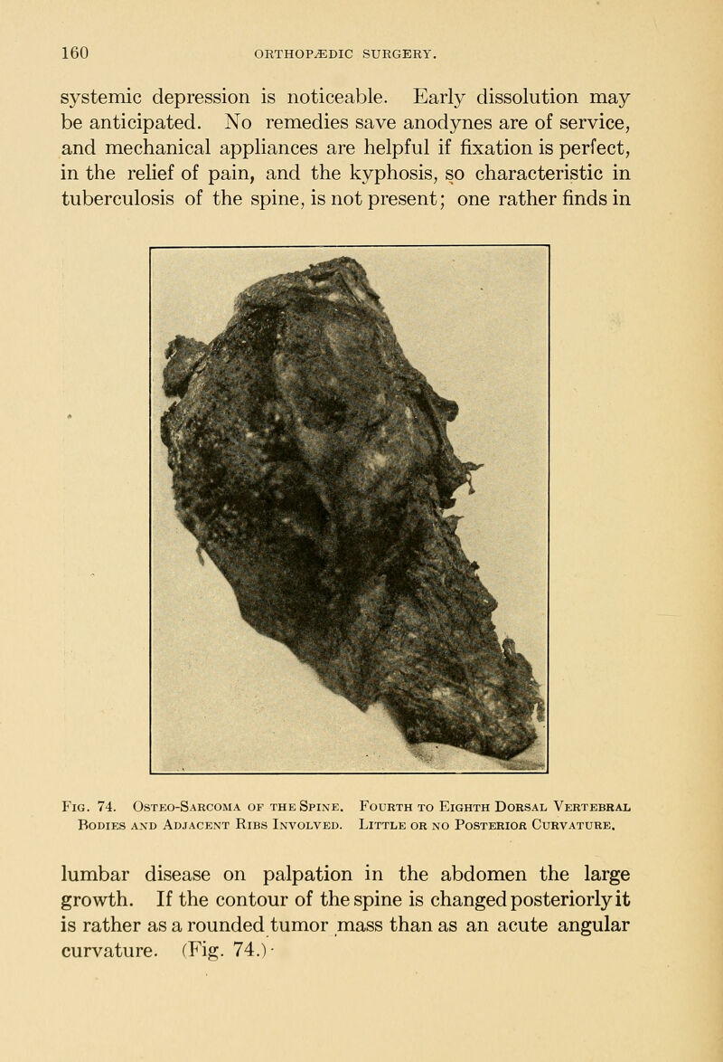 systemic depression is noticeable. Early dissolution may be anticipated. No remedies save anodynes are of service, and mechanical appliances are helpful if fixation is perfect, in the relief of pain, and the kyphosis, so characteristic in tuberculosis of the spine, is not present; one rather finds in Fig. 74. Osteo-Sarcoma of the Spine. Bodies and Adjacent Ribs Involved. Fourth to Eighth Dorsal Vertebral Little or no Posterior Curvature. lumbar disease on palpation in the abdomen the large growth. If the contour of the spine is changed posteriorly it is rather as a rounded tumor mass than as an acute angular curvature. (^Fig. 74.)-