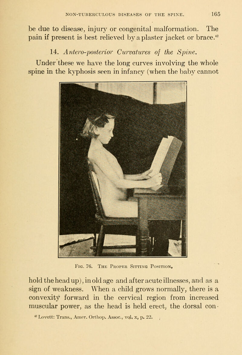 be due to disease, injury or congenital malformation. The pain if present is best relieved by a plaster jacket or brace.^ 14. Antero-posterior Curvatures of the Spine. Under these we have the long curves involving the whole spine in the kyphosis seen in infancy (when the baby cannot Fig. 76. The Proper Sitting Position, hold the head up), in old age and after acute illnesses, and as a sign of weakness. When a child grows normally, there is a convexity forward in the cervical region from increased muscular power, as the head is held erect, the dorsal con- *^Lovett: Trans., Arncr. Orthop. Assoc, vol. x, p. 22. j
