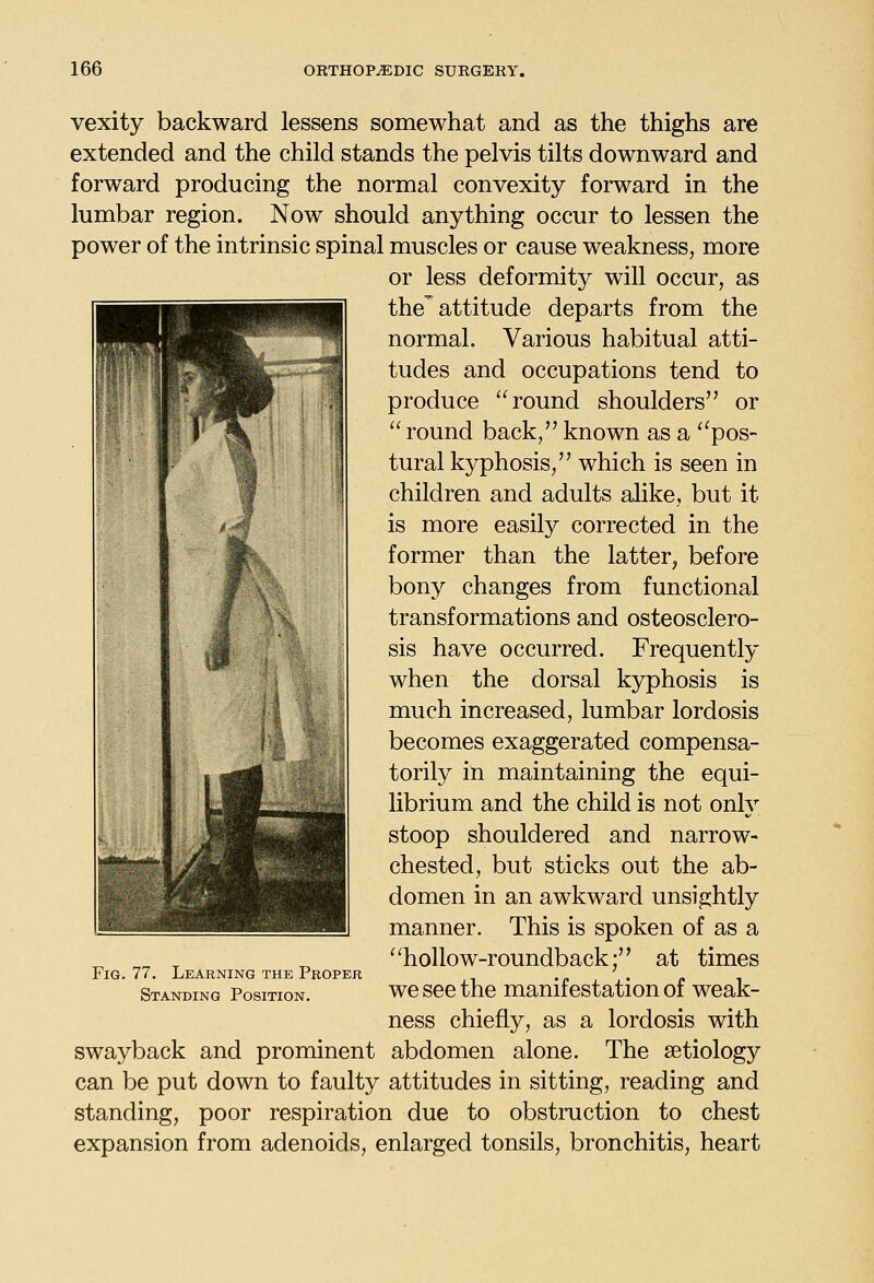 vexity backward lessens somewhat and as the thighs are extended and the child stands the pelvis tilts downward and forward producing the normal convexity forward in the lumbar region. Now should anything occur to lessen the power of the intrinsic spinal muscles or cause weakness, more or less deformity will occur, as the'attitude departs from the normal. Various habitual atti- tudes and occupations tend to produce round shoulders or  round back, known as a ^^pos- tural kyphosis, which is seen in children and adults alike, but it is more easily corrected in the former than the latter, before bony changes from functional transformations and osteosclero- sis have occurred. Frequently when the dorsal kyphosis is much increased, lumbar lordosis becomes exaggerated compensa- torily in maintaining the equi- librium and the child is not only stoop shouldered and narrow- chested, but sticks out the ab- domen in an awkward unsightly manner. This is spoken of as a ^^hollow-roundback; at times we see the manifestation of weak- ness chiefly, as a lordosis with swayback and prominent abdomen alone. The aetiology can be put down to faulty attitudes in sitting, reading and standing, poor respiration due to obstruction to chest expansion from adenoids, enlarged tonsils, bronchitis, heart Fig. 77. Learning the Proper Standing Position.