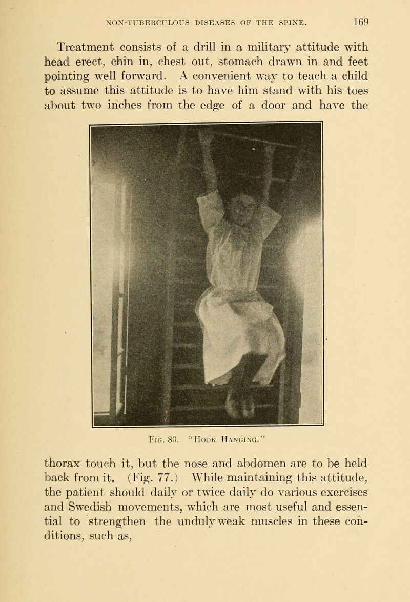 Treatment consists of a drill in a military attitude with head erect, chin in^ chest out, stomach drawn in and feet pointing well forward. A convenient way to teach a child to assume this attitude is to have him stand with his toes about two inches from the edge of a door and have the Fig. so. Hook Hanging. thorax touch it, but the nose and abdomen are to be held back from it. (Fig. 77.) While maintaining this attitude, the patient should daily or twice daily do various exercises and Swedish movements, which are most useful and essen- tial to strengthen the unduly weak muscles in these con- ditions, such as,