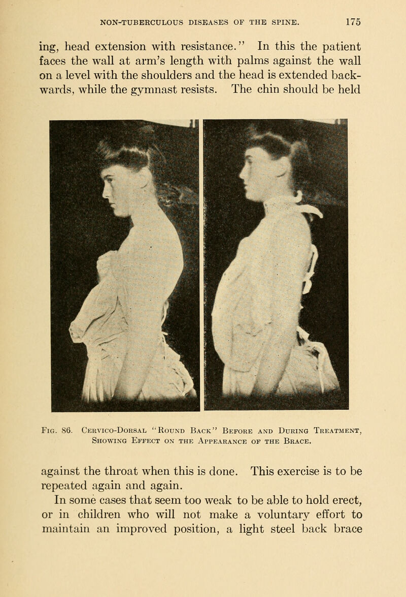 ing, head extension with resistance. In this the patient faces the wall at arm's length with palms against the wall on a level with the shoulders and the head is extended back- wards, while the gymnast resists. The chin should be held Fig. 86. Cervico-Dorsal Round Back Before and During Treatment, Showing Effect on the Appearance of the Brace. against the throat when this is done. This exercise is to be repeated again and again. In some cases that seem too weak to be able to hold erect, or in children who will not make a voluntary effort to maintain an improved position, a light steel back brace