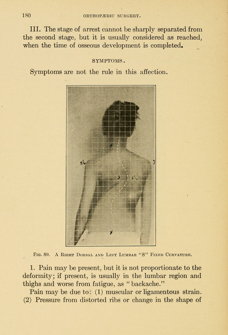 III. The stage of arrest cannot be sharply separated from the second stage, but it is usually considered as reached, when the time of osseous development is completed. SYMPTOMS. Symptoms are not the rule in this affection. Fig. 89. A Right Dorsal and Left Lumbar S Fixed Curvature. 1. Pain may be present, but it is not proportionate to the deformity; if present, is usually in the lumbar region and thighs and worse from fatigue, as backache. Pain may be due to: (1) muscular or ligamentous strain. (2) Pressure from distorted ribs or change in the shape of