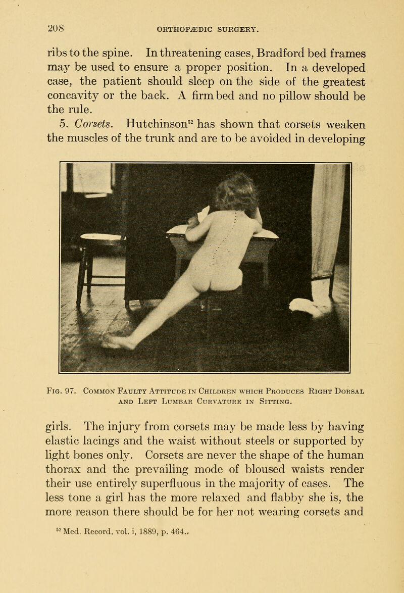 ribs to the spine. In threatening cases, Bradford bed frames may be used to ensure a proper position. In a developed case, the patient should sleep on the side of the greatest concavity or the back. A firm bed and no pillow should be the rule. 5. Corsets. Hutchinson^^ has shown that corsets weaken the muscles of the trunk and are to be avoided in developing Fig. 97. Common Faulty Attitude in Children which Produces Right Dorsal AND Left Lumbar Curvature in Sitting. girls. The injury from corsets may be made less by having elastic lacings and the waist without steels or supported by light bones only. Corsets are never the shape of the human thorax and the prevailing mode of bloused waists render their use entirely superfluous in the majority of cases. The less tone a girl has the more relaxed and flabby she is, the more reason there should be for her not wearing corsets and Med. Record, vol. i, 1889, p. 464.,