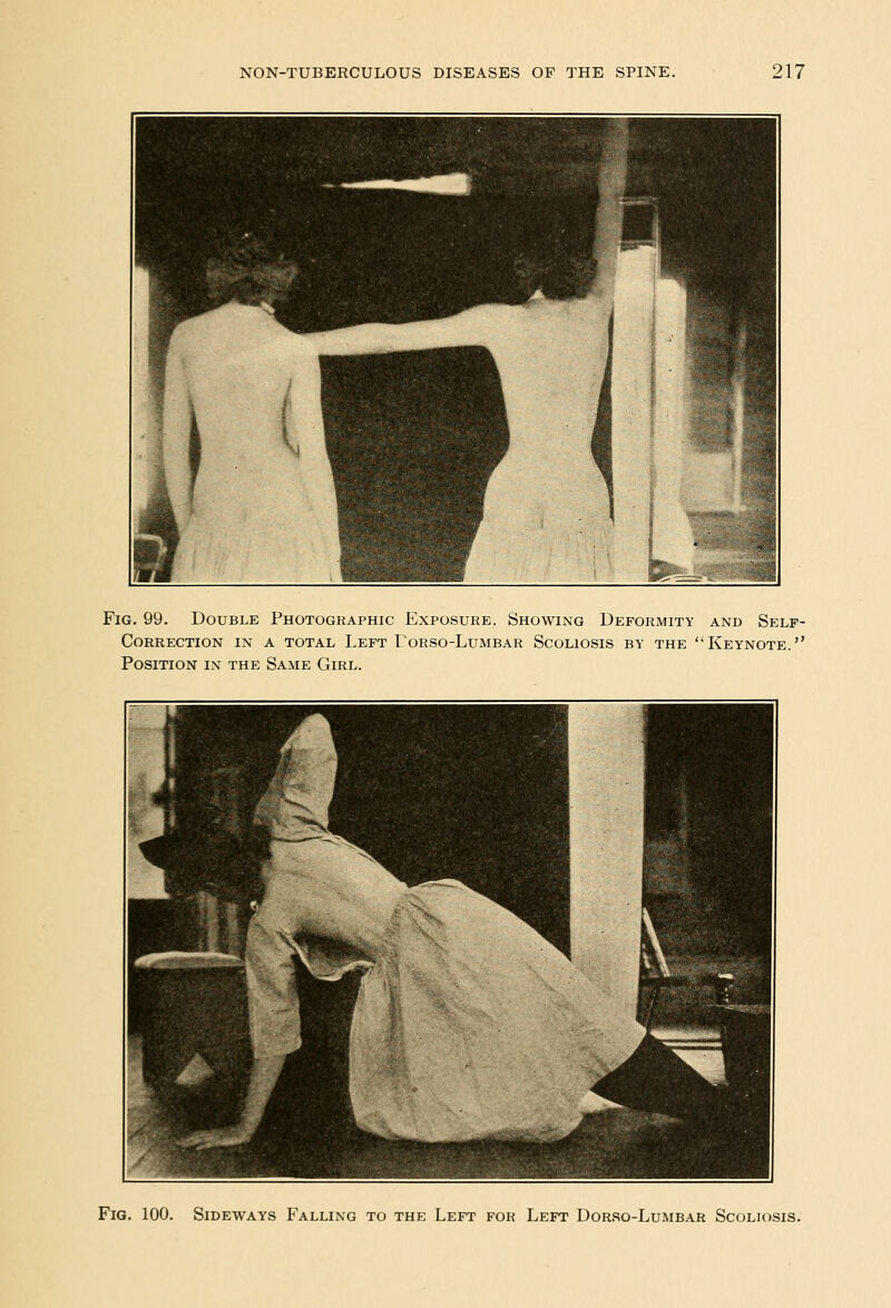 Fig. 99. Double Photographic Exposure, Showing Deformity and Self- Correction IN A TOTAL Left Torso-Lumbar Scoliosis by the Keynote. Position in the Same Girl. Fig. 100. Sideways Falling to the Left for Left Dorso-Lumbar Scoliosis.