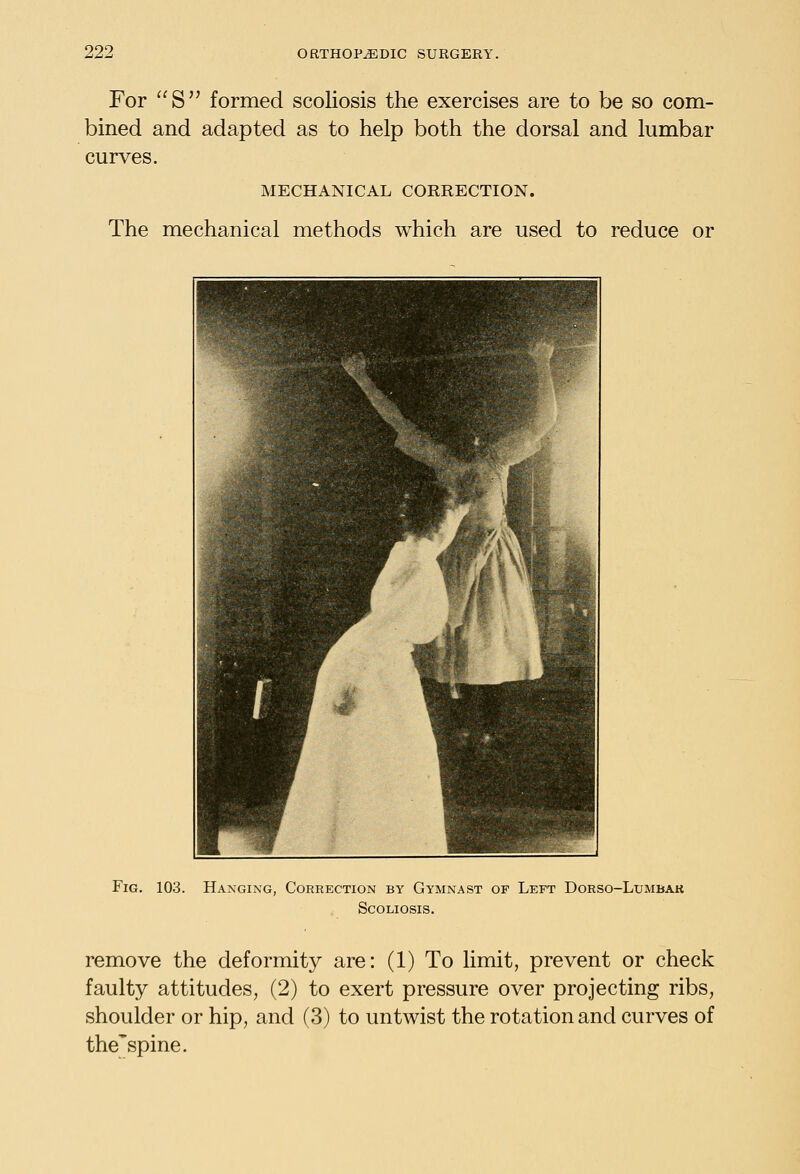 For S formed scoliosis the exercises are to be so com- bined and adapted as to help both the dorsal and lumbar curves. MECHANICAL CORRECTION. The mechanical methods which are used to reduce or Fig. 103. Hanging, Correction by Gymnast of Left Dorso-Lumbak Scoliosis. remove the deformity are: (1) To limit, prevent or check faulty attitudes, (2) to exert pressure over projecting ribs, shoulder or hip, and (3) to untwist the rotation and curves of the'spine.