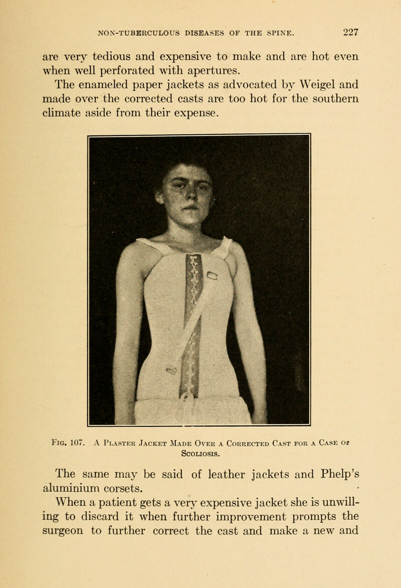 are very tedious and expensive to make and are hot even when well perforated with apertures. The enameled paper jackets as advocated by Weigel and made over the corrected casts are too hot for the southern cUmate aside from their expense. Fig. 107. A Plaster Jacket Made Over a Corrected Cast for a Case Of Scoliosis. The same may be said of leather jackets and Phelp's aluminium corsets. When a patient gets a very expensive jacket she is unwill- ing to discard it when further improvement prompts the surgeon to further correct the cast and make a new and