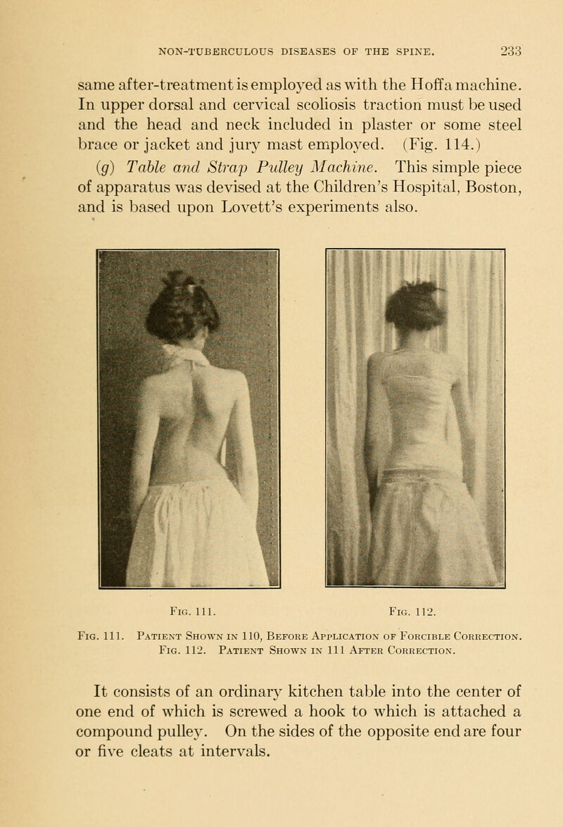 same after-treatment is employed as with the Hoffa machine. In upper dorsal and cervical scoliosis traction must be used and the head and neck included in plaster or some steel brace or jacket and jury mast employed. (Fig. 114.) (g) Table and Strap Pulley Machine. This simple piece of apparatus was devised at the Children's Hospital, Boston, and is based upon Lovett's experiments also. Fig.111. Fig. 112. Fig. 111. Patient Shown in 110, Before Application of Forcible Correction. Fig. 112. Patient Shown in 111 After Correction. It consists of an ordinary kitchen table into the center of one end of which is screwed a hook to which is attached a compound pulley. On the sides of the opposite end are four or five cleats at intervals.