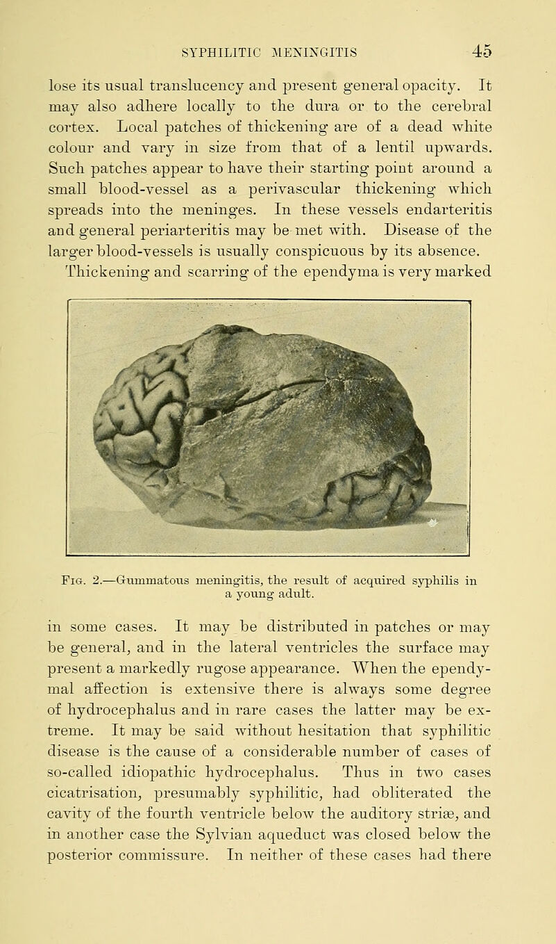 lose its usual translucency and present general opacity. It may also adhere locally to the dura or to the cerebral cortex. Local patches of thickening are of a dead white colour and vary in size from that of a lentil upwards. Such patches appear to have their starting point around a small blood-vessel as a perivascular thickening which spreads into the meninges. In these vessels endarteritis and general periarteritis may be met with. Disease of the larger blood-vessels is usually conspicuous by its absence. Thickening and scarring of the ependyma is very marked Fig. 2.—Gimimatcais meningitis, the result of acquired syphilis in a young adult. in some cases. It may be distributed in patches or may be general, and in the lateral ventricles the surface may present a markedly rugose appearance. When the ependy- mal affection is extensive there is always some degree of hydrocephalus and in rare cases the latter may be ex- treme. It may be said without hesitation that syphilitic disease is the cause of a considerable number of cases of so-called idiopathic hydrocephalus. Thus in two cases cicatrisation, presumably syphilitic, had obliterated the cavity of the fourth ventricle below the auditory stria3, and in another case the Sylvian aqueduct was closed below the posterior commissure. In neither of these cases had there