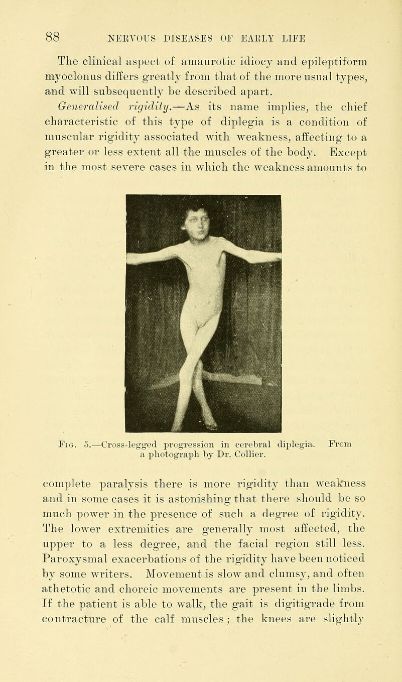 The clinical aspect of amaurotic idiocy and epileptiform myoclonus differs greatly from that of the more usual types, and will subsequently be described apart. Generalised rigidity.—As its name implies, the chief characteristic of this type of diplegia is a condition of muscular rigidity associated with weakness, affecting to a greater or less extent all the muscles of the body. Except in the most severe cases in which the weakness amounts to Fig. 5.—Cross-legged progression in cerebral diplegia. From a photograph by Dr. Collier. complete paralysis there is more rigidity than weakness and in some cases it is astonishing that there should be so much power in the presence of such a degree of rigidity. The lower extremities are generally most affected, the upper to a less degree, and the facial region still less. Paroxysmal exacerbations of the rigidity have been noticed by some writers. Movement is slow and clumsy, and often athetotic and choreic movements are present in the limbs. If the patient is able to walk, the gait is digitigrade from contracture of the calf muscles ; the knees are slightly