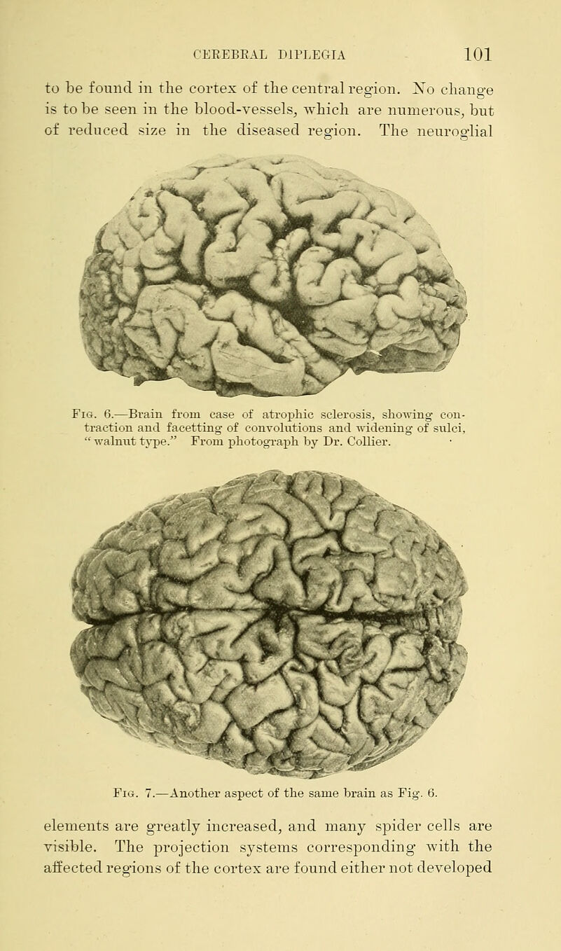 to be found in the cortex of the central region. No change is to be seen in the blood-vessels, which are numerous, but of reduced size in the diseased region. The neuroglial Fig. 6.—Bvain from case of atrophic sclerosis, showing con- traction and facetting of convolutions and widening of sulci,  walnut type. From photograph by Dr. Collier. < < ,X V ' * f- . i '-. ■■ Fig. 7.—Another aspect of the same brain as Fig. 6. elements are greatly increased, and many spider cells are visible. The projection systems corresponding with the affected regions of the cortex are found either not developed