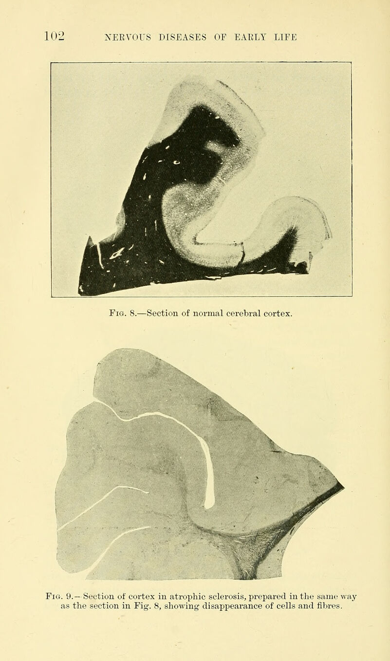 Fig. 8.—Section of normal cerebral cortex. Fig. 9.— Section of cortex in atrophic sclerosis, prepared in the same way as the section in Fig. 8, showing disappearance of cells and fibres.