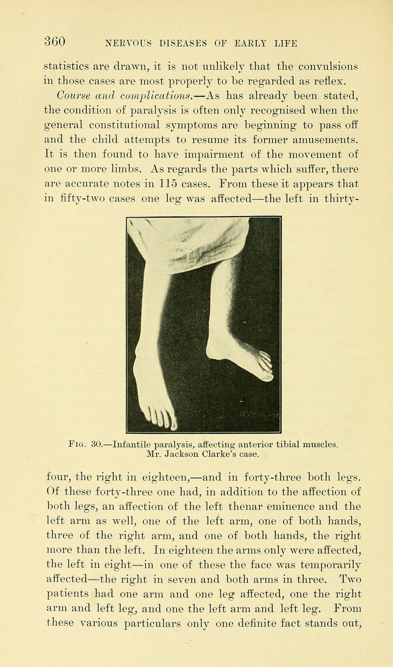 statistics are drawn, it is not unlikely that the convulsions in those cases are most properly to be regarded as reflex. Course and complications.—As has already been stated, the condition of paralysis is often only recognised when the general constitutional symptoms are beginning to pass off and the child attempts to resume its former amusements. It is then found to have impairment of the movement of one or more limbs. As regards the parts which suffer, there are accurate notes in 115 cases. From these it appears that in fifty-two cases one leg was affected—the left in thirty- Fig. 30.—Infantile paralysis, affecting anterior tibial muscles. Mr. Jackson Clarke's case. four, the right in eighteen,—and in forty-three both legs. Of these forty-three one had, in addition to the affection of both legs, an affection of the left thenar eminence and the left arm as well, one of the left arm, one of both hands, three of the right arm, and one of both hands, the right more than the left. In eighteen the arms only were affected, the left in eight—in one of these the face was temporarily affected—the right in seven and both arms in three. Two patients had one arm and one leg affected, one the right arm and left leg, and one the left arm and left leg. From these various particulars only one definite fact stands out,