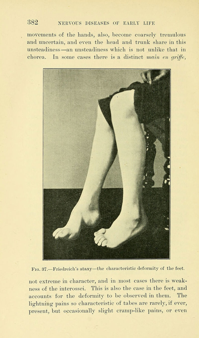 movements of the hands, also, become coarsely tremulous and uncertain, and even the head and trunk share in this unsteadiness—an unsteadiness which is not unlike that in chorea. In some cases there is a distinct main en griffe, Fig. 37.—Friedreich's ataxy—the characteristic deformity of the feet. not extreme in character, and in most cases there is weak- ness of the interossei. This is also the case in the feet, and accounts for the deformity to be observed in them. The lightning pains so characteristic of tabes are rarely, if ever, present, but occasionally slight cramp-like pains, or even