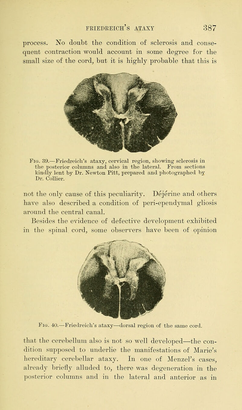 process. No doubt the condition of sclerosis and conse- quent contraction would account in some degree for the small size of the cord, but it is highly probable that this is Fig. 39.—Friedreich's ataxy, cervical region, showing sclerosis in the posterior columns and also in the lateral. From sections kindly lent by Dr. Newton Pitt, prepared and photographed by Dr. Collier. not the only cause of this peculiarity. Dejerine and others have also described a condition of peri-ependymal gliosis around the central canal. Besides the evidence of defective development exhibited in the spinal cord, some observers have been of opinion Fig. 40.—Friedreich's ataxy—dorsal region of the same cord. that the cerebellum also is not so well developed—the con- dition supposed to underlie the manifestations of Marie's hereditary cerebellar ataxy. In one of MenzeFs cases, already briefly alluded to, there was degeneration in the posterior columns and in the lateral and anterior as in