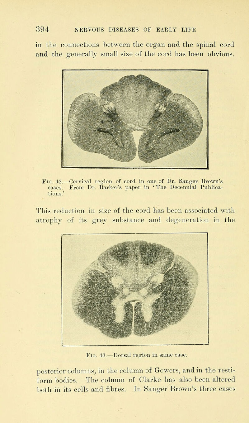 iii the connections between the organ and the spinal cord and the generally small size of the cord has been obvious. Fig. 42.—Cervical region of cord in one of Dr. Sanger Brown's cases. From Dr. Barker's paper in ' The Decennial Publica- tions.' This reduction in size of the cord has been associated with atrophy of its grey substance and degeneration in the Fig. 43.—Dorsal region in same case. posterior columns, in the column of Growers, and in the resti- form bodies. The column of Clarke has also been altered both in its cells and fibres. In Sanger Brown's three cases