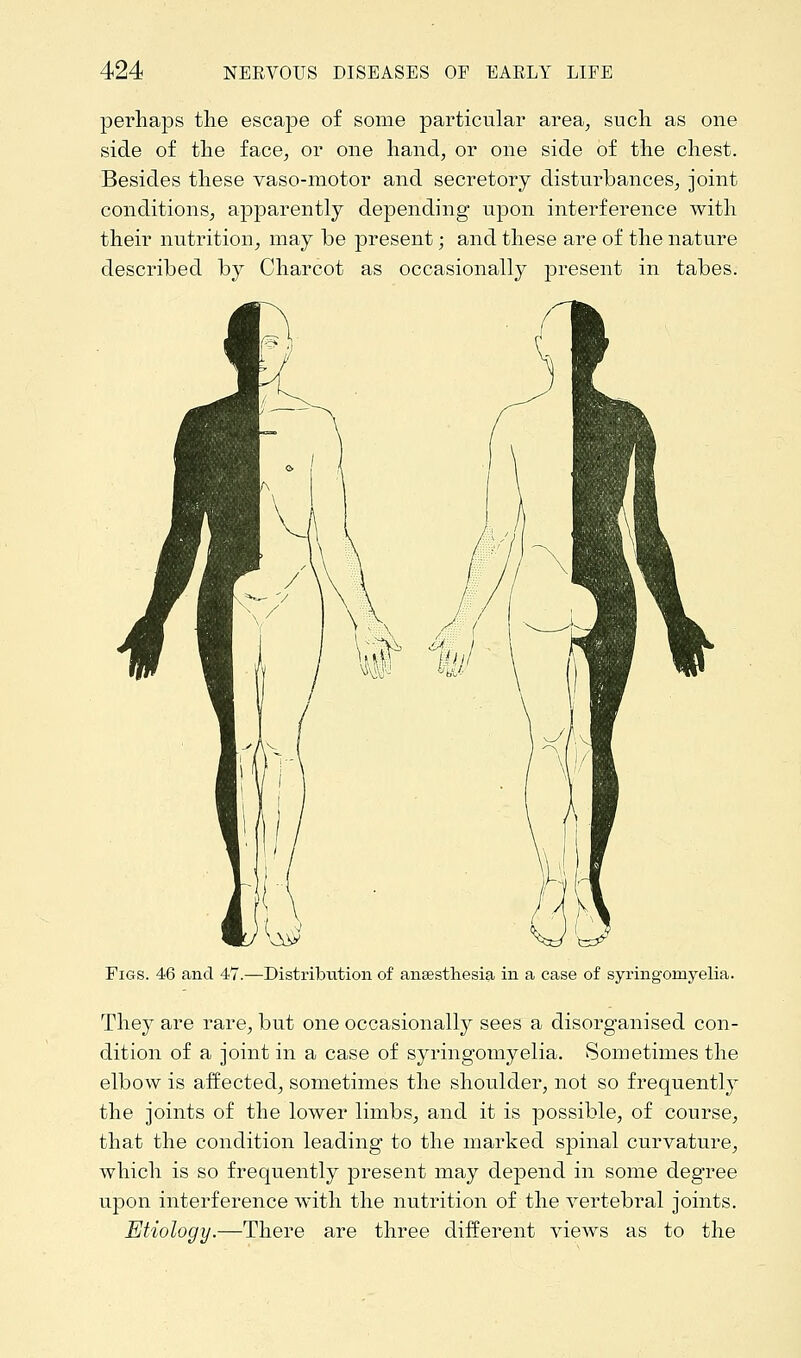 perhaps the escape of some particular area, such as one side of the face, or one hand, or one side of the chest. Besides these vaso-motor and secretory disturbances, joint conditions, apparently depending upon interference with their nutrition, may be present; and these are of the nature described by Charcot as occasionally present in tabes. Figs. 46 and 47.—Distribution of anaesthesia in a case of syringomyelia. They are rare, but one occasionally sees a disorganised con- dition of a joint in a case of syringomyelia. Sometimes the elbow is affected, sometimes the shoulder, not so frequently the joints of the lower limbs, and it is possible, of course, that the condition leading to the marked spinal curvature, which is so frequently present may depend in some degree upon interference with the nutrition of the vertebral joints. Etiology.—There are three different views as to the