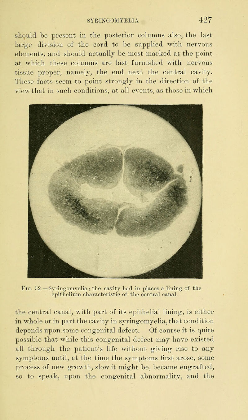 should be present in the posterior columns also, the last large division of the cord to be supplied with nervous elements, and should actually be most marked ac the point at which these columns are last furnished with nervous tissue proper, namely, the end next the central cavity. These facts seem to point strongly in the direction of the view that in such conditions, at all events, as those in which Fig. 52.—Syringomyelia; the cavity had in places a lining of the epithelium characteristic of the central canal. the central canal, with part of its epithelial lining, is either in whole or in part the cavity in syringomyelia, that condition depends upon some congenital defect. Of course it is quite possible that while this congenital defect may have existed all through the patient's life without giving rise to any symptoms until, at the time the symptoms first arose, some process of new growth, slow it might be, became engrafted, so to speak, upon the congenital abnormality, and the