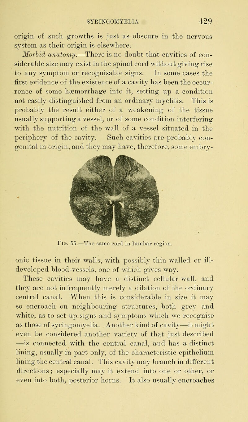 origin of such growths is just as obscure in the nervous system as their origin is elsewhere. Morbid anatomy.—There is no doubt that cavities of con- siderable size may exist in the spinal cord without giving rise to any symptom or recognisable signs. In some cases the first evidence of the existence of a cavity has been the occur- rence of some haemorrhage into it, setting up a condition not easily distinguished from an ordinary myelitis. This is probably the result either of a weakening of the tissue usually supporting a vessel, or of some condition interfering Avith the nutrition of the wall of a vessel situated in the periphery of the cavity. Such cavities are probably con- genital in origin, and they may have, therefore, some embry- Fig. 55.—The same cord in lumbar region. onic tissue in their walls, with possibly thin walled or ill- developed blood-vessels, one of which gives way. These cavities may have a distinct cellular wall, and they are not infrequently merely a dilation of the ordinaiy central canal. When this is considerable in size it may so encroach on neighbouring structures, both grey and white, as to set up- signs and symptoms which we recognise as those of syringomyelia. Another kind of cavity—it might even be considered another variety of that just described —is connected with the central canal, and has a distinct lining, usually in part only, of the characteristic epithelium lining the central canal. This cavity may branch in different directions; especially may it extend into one or other, or even into both, posterior horns. It also usually encroaches