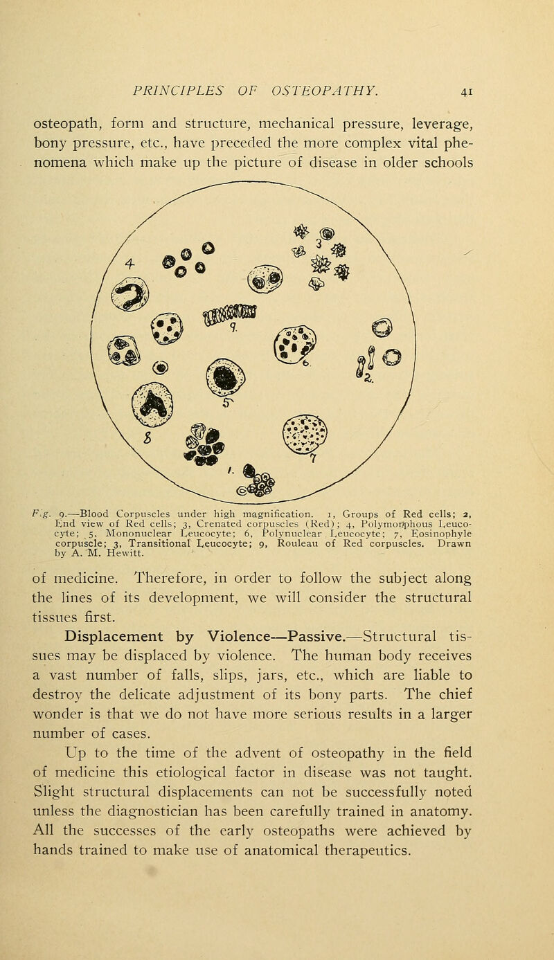 osteopath, form and structure, mechanical pressure, leverage, bony pressure, etc., have preceded the more complex vital phe- nomena which make up the picture of disease in older schools F.g. g.—Blood Corpuscles under high magnification. i, Groups of Red cells; 2, End view of Red cells; 3, Crenated corpuscles (Red); 4, Polymorjphous Leuco- cyte; 5. Mononuclear Leucocyte; 6, Polynuclear Leucocyte; 7, Eosinophyle corpuscle; 3, Transitional Leucocyte; 9, Rouleau of Red corpuscles. Drawn by A. M. Hewitt. of medicine. Therefore, in order to follow the subject along the lines of its development, we will consider the structural tissues first. Displacement by Violence—Passive.—Structural tis- sues may be displaced by violence. The human body receives a vast number of falls, slips, jars, etc., which are liable to destroy the delicate adjustment of its bony parts. The chief wonder is that we do not have more serious results in a larger number of cases. Up to the time of the advent of osteopathy in the field of medicine this etiological factor in disease was not taught. Slight structural displacements can not be successfully noted unless the diagnostician has been carefully trained in anatomy. All the successes of the early osteopaths were achieved by hands trained to make use of anatomical therapeutics.