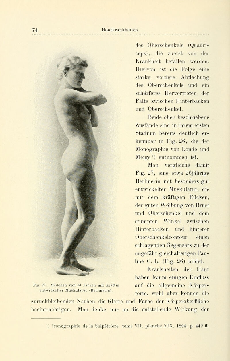 des Obersclienkels (Quadri- ceps), die zuerst von der Krankheit befallen werden. Hiervon ist die Folge eine starke vordere Abflacliung des Oberschenkels und ein schärferes Hervortreten der Falte zwischen Hinterbacken und Oberschenkel. Beide oben beschriebene Zustände sind in ihrem ersten Stadium bereits deutlich er- kennbar in Fig. 26, die der Monographie von Londe und Meige ^) entnommen ist. Man vergleiche damit Fig. 27, eine etwa 26jährige Berlinerin mit besonders gut entwickelter Muskulatur, die mit dem kräftigen Rücken, der guten Wölbung von Brust und Oberschenkel und dem stumpfen Winkel zwischen Hinterbacken und hinterer Oberschenkelcontour einen schlagenden Gegensatz zu der ungefähr gleichalterigen Pau- line C. L. (Fig. 26) bildet. Krankheiten der Haut haben kaum einigen Einfiuss auf die allgemeine Körper- form, wohl aber können die zurückbleibenden Narben die Glätte und Farbe der Körperoberfläche beeinträchtig'en. Man denke nur an die entstellende Wirkung; der Fig. 27. Mädchen von 2ü Jahi-en mit kräftig entwickelter Musliulatur (Berlinerin). IconograpHe de la Salpetriere, tome VII, planche XIX, 1894, p. 442 ff.