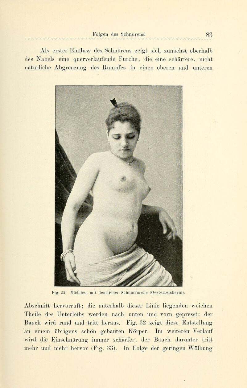 Als erster Einfluss des Schnürens zeigt sich zunächst oberhalb des Nabels eine querverlaufende Furche, die eine schärfere, nicht natürliche Abgrenzung' des Rumpfes in einen oberen und unteren Fig. 32. Mädchen mit deutliclier Scliiiürfurche (Oesterreiclierin). Abschnitt hervorruft; die unterhalb dieser Linie liegenden weichen Theile des Unterleibs werden nach unten und vorn gepresst: der Bauch wird rund und tritt heraus. Fig. 32 zeigt diese Entstellung an einem übrigens schön gebauten Körper. Im weiteren Verlauf wird die Einschnürung immer schärfer, der Bauch darunter tritt
