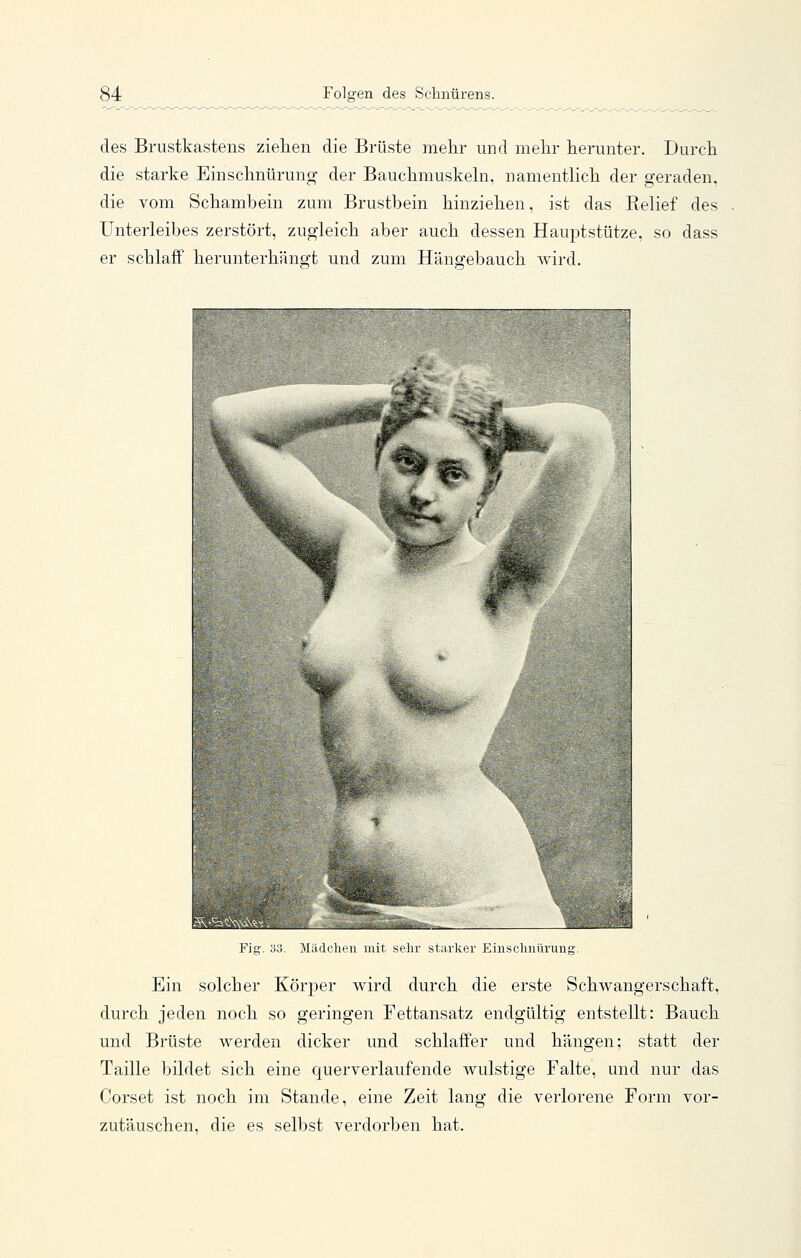 des Brustkastens ziehen die Brüste mehr und melir herunter. Durch die starke Einschnüruncr der Bauchmuskehi, namentlich der geraden, die vom Schambein zum Brustbein hinziehen, ist das Relief des Unterleibes zerstört, zugleich aber auch dessen Hauptstütze, so dass er schlaff herunterhängt und zum Hängebauch wird. Fig. 33. Mädchen mit sehr staiiier Einschnürung. Ein solcher Körper wird durch die erste Schwangerschaft, durch jeden noch so geringen Fettansatz endgültig entstellt: Bauch und Brüste werden dicker und schlaffer und hängen; statt der Taille bildet sich eine querverlaufende wulstige Falte, und nur das Corset ist noch im Stande, eine Zeit lang die verlorene Form vor- zutäuschen, die es selbst verdorben hat.
