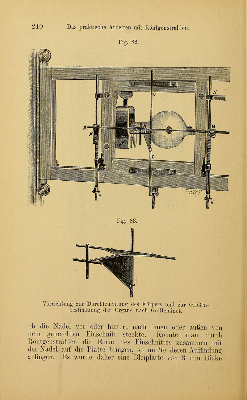 -j .{ !« Das praktische Arbeiten mit Röntgenstrahlen. Fig. 82. Fig. 83. Vorrichtung zur Durchleuchtung des Körpers und zur Größen- bestimmung der Organe nach Guilleminot. ob die Nadel vor oder hinter, nach innen oder außen von dem gemachten Einschnitt steckte. Konnte man durch Röntgenstrahlen die Ebene des Einschnittes zusammen mit der Nadel auf die Platte bringen, so mußte deren Auffindung gelingen. Es wurde daher eine Bleiplatte von 3 mm Dicke
