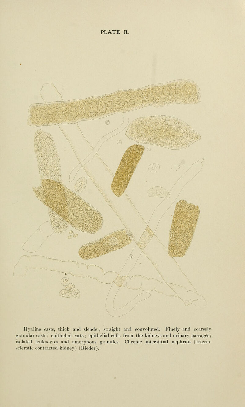 Hyaline casts, thick and slender, straight and convoluted. Finely and coarsely granular casts; epithelial casts ; epithelial cells from the kidneys and urinary passages; isolated leukocytes and amorphous granules. Chronic interstitial nephritis (arterio- sclerotic contracted kidney) (Rieder).