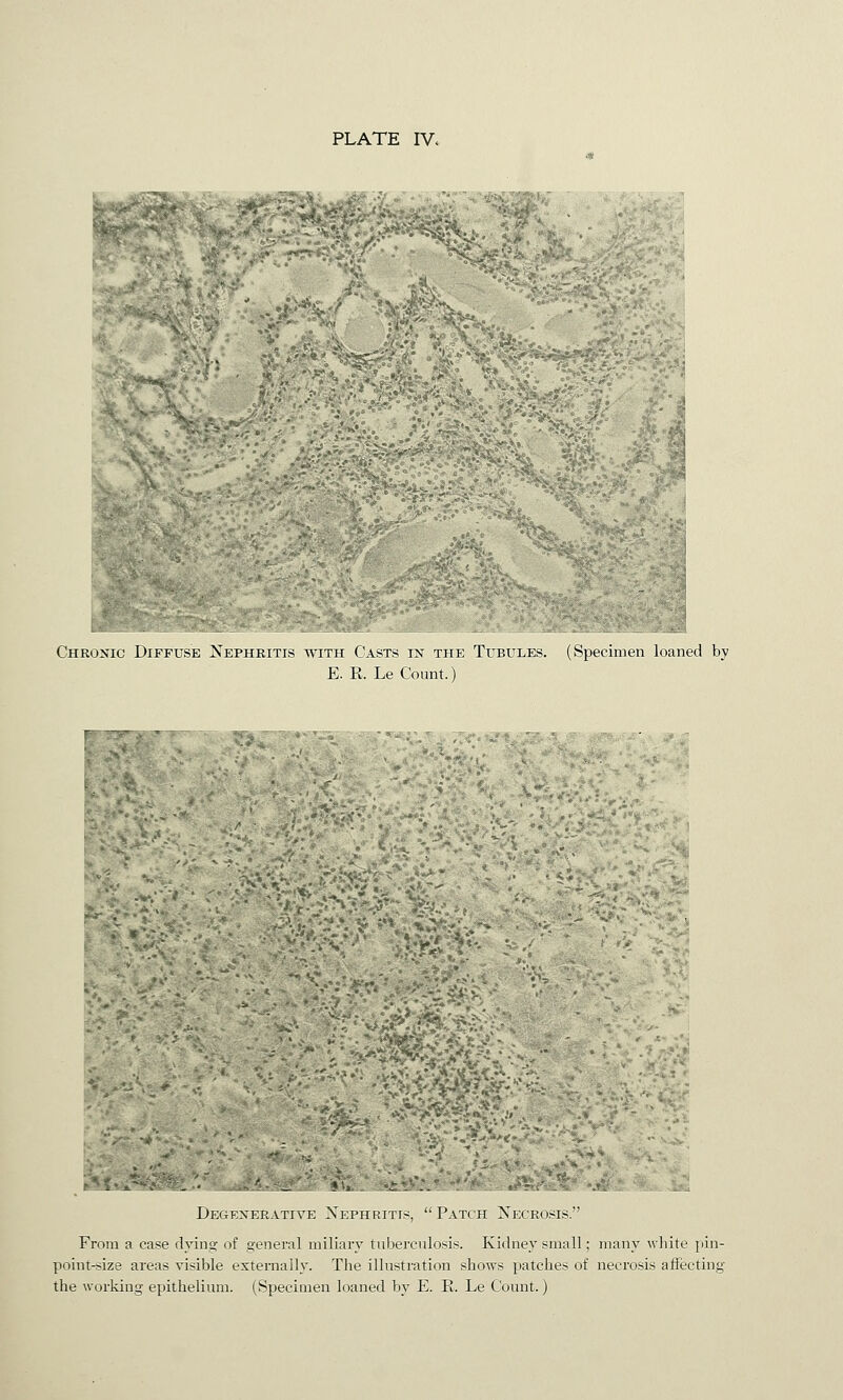 PLATE IV. Chronic Diffuse Nephritis with Casts in the Tubules. E. R. Le Count.) (Specimen loaned by Degenerative Xephritts, Patch Necrosis. From a case dying of general miliary tuberculosis. Kidney small; many white pin- point-size areas visible externally. The illustration shows patches of necrosis affecting the working epithelium. (Specimen loaned by E. P. Le Count.)