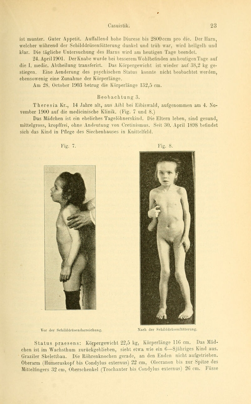 ist munter. Guter Appetit. Auffallend hohe Diureso bis 2800ccm pro die. Der Harn, welcher während der Schilddrüsenfiitterung duni<cl und trüb war, wird hellgelb und klar. Die tägliche Untersuchung des Harns wird am heutigen Tage beendet. 24. Aprill901. Der Knabe wurde bei besserem Wohlbefinden am heutigen Tage auf die 1. medic. Abtheilung transferirt. Das Körpergewicht ist wieder auf 38,2 kg ge- stiegen. Eine Aenderung des psychischen Status konnte nicht beobachtet werden, ebensowenig eine Zunahme der Körperlänge. Am 28. October 1903 betrug die Körperlänge 132,5 cm. Beobachtung 3. Theresia Kr., 14 Jahre alt, aus Aibl bei Eibiswald, aufgenommen am 4. No- vember 1900 auf die medicinische Klinik. (Fig. 7 und 8.) Das Mädchen ist ein eheliches Tagelöhnerskind. Die Eltern leben, sind gesund, mittelgross, kropffrei, ohne Andeutung von Cretinismus. Seit 30. April 1898 befindet sich das Kind in Pileae des Siechenhauses in Knittelfeld. Fio-. 7. Fig. 8. Vor der Seliilddriisendarreichung. Nacli der Schilddrüsenfiitterung. Status praesens: Körpergewicht 22,5 kg, Körperlänge 116 cm. Das Mäd- chen ist im Wachsthum zurückgeblieben, sieht etwa wie ein 6—8jähriges Kind aus. Graziler Skelettbau. Die Röhrenknochen gerade, an den Enden nicht aufgetrieben. Oberarm (Humeruskopf bis Condylus esternus) 22 cm, Olecranon bis zur Spitze des Mittelfingers 32 cm, Oberschenkel (Trochanter bis Condylus externus) 26 cm. Füsse