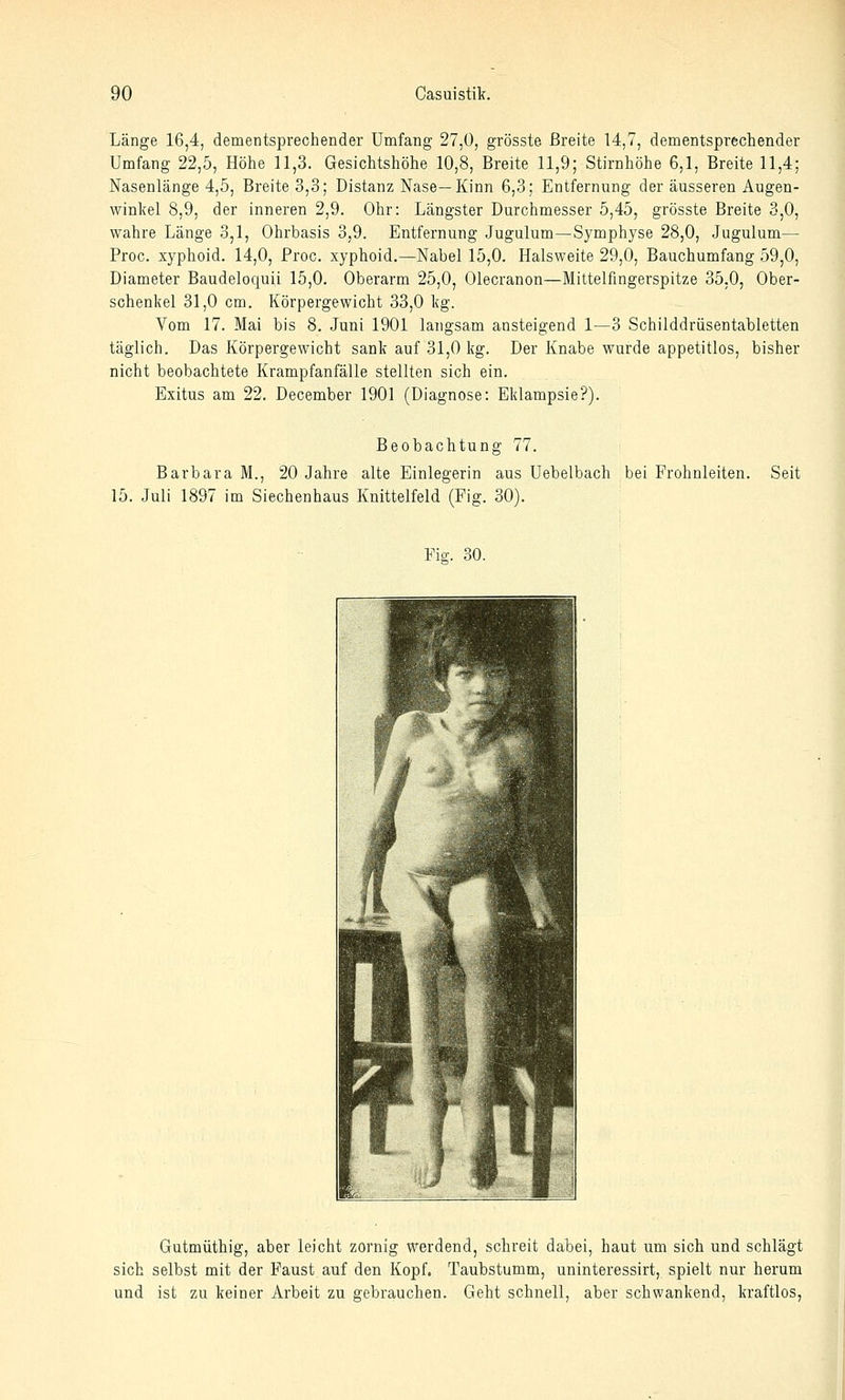 Länge 16,4, dementsprechender Umfang 27,0, grösste Breite 14,7, dementsprechender Umfang 22,5, Höhe 11,3. Gesichtshöhe 10,8, Breite 11,9; Stirnhöhe 6,1, Breite 11,4; Nasenlänge 4,5, Breite 3,3; Distanz Nase—Kinn 6,3; Entfernung der äusseren Augen- winkel 8,9, der inneren 2,9. Ohr: Längster Durchmesser 5,45, grösste Breite 3,0, wahre Länge 3,1, Ohrbasis 3,9. Entfernung Jugulum—Symphyse 28,0, Jugulum— Proc. xyphoid. 14,0, Proc. xyphoid.—Nabel 15,0. Halsweite 29,0, Bauchumfang 59,0, Diameter Baudeloquii 15,0. Oberarm 25,0, Olecranon—Mittelfingerspitze 35,0, Ober- schenkel 31,0 cm. Körpergewicht 33,0 kg. Vom 17. Mai bis 8. Juni 1901 langsam ansteigend 1—3 Schilddrüsentabletten täglich. Das Körpergewicht sank auf 31,0 kg. Der Knabe wurde appetitlos, bisher nicht beobachtete Krampfanfälle stellten sich ein. Exitus am 22. December 1901 (Diagnose: Eklampsie?). Beobachtung 77. Barbara M., 20 Jahre alte Einlegerin aus Uebelbach bei Frohnleiten. 15. Juli 1897 im Siechenhaus Knittelfeld (Fig. 30). Seit Fig. 30. Gutmüthig, aber leicht zornig werdend, schreit dabei, haut um sich und schlägt sich selbst mit der Faust auf den Kopf. Taubstumm, uninteressirt, spielt nur herum und ist zu keiner Arbeit zu gebrauchen. Geht schnell, aber schwankend, kraftlos,