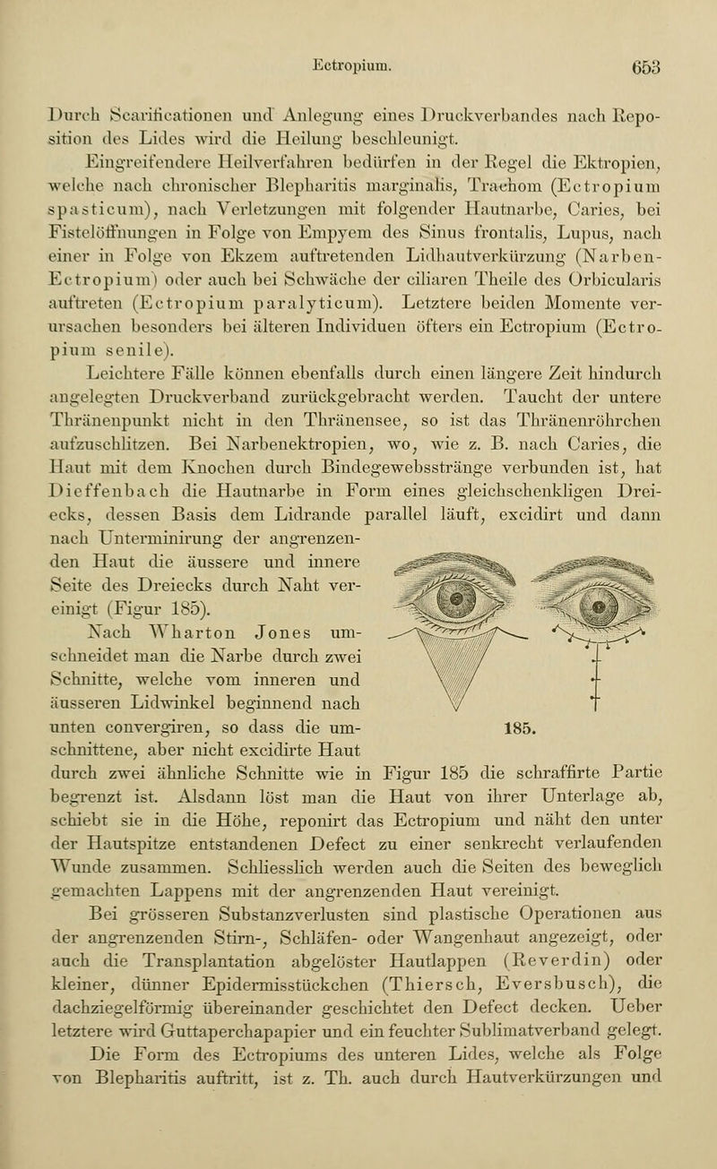 Durch Searitieationen und Anlegung eines Druckverbandes nach Repo- sition des Lides wird die Heilung beschleunigt. Eingreifendere Heilverfahren bedürfen in der Regel die Ektropien, welche nach chronischer Blepharitis marginans, Trachom (Ectropium spasticum), nach Verletzungen mit folgender Hautnarbe, Caries, bei Fistelöffnungen in Folge von Empvein des Sinus frontalis, Lupus, nach einer in Folge von Ekzem auftretenden Lidhautverkürzung (Narben- Ectropium) oder auch bei Schwäche der ciliaren Theile des Orbicularis auftreten (Ectropium paralyticum). Letztere beiden Momente ver- ursachen besonders bei älteren Individuen öfters ein Ectropium (Ectro- pium senile). Leichtere Fälle können ebenfalls durch einen längere Zeit hindurch angelegten Druckverband zurückgebracht werden. Taucht der untere Thränenpunkt nicht in den Thränensee, so ist das Thränenröhrchen aufzuschlitzen. Bei Narbenektropien, wo, wie z. B. nach Caries, die Haut mit dem Knochen durch Bindegewebsstränge verbunden ist, hat Dieffenbach die Hautnarbe in Form eines gleichschenkligen Drei- ecks, dessen Basis dem Lidrande parallel läuft, excidirt und dann nach Unterminirung der angrenzen- den Haut die äussere und innere Seite des Dreiecks durch Naht ver- einigt (Figur 185). Nach Wharton Jones um- schneidet man die Narbe durch zwei Schnitte, welche vom inneren und äusseren Lidwinkel beginnend nach unten convergiren, so dass die um- schnittene, aber nicht excidirte Haut 185. Figur 185 die schraffirte Partie Haut von ihrer Unterlage ab, durch zwei ähnliche Schnitte wie in begrenzt ist. Alsdann löst man die schiebt sie in die Höhe, reponirt das Ectropium und näht den unter der Hautspitze entstandenen Defect zu einer senkrecht verlaufenden Wunde zusammen. Schliesslich werden auch die Seiten des beweglich gemachten Lappens mit der angrenzenden Haut vereinigt. Bei grösseren Substanzverlusten sind plastische Operationen aus der angrenzenden Stirn-, Schläfen- oder Wangenhaut angezeigt, oder auch die Transplantation abgelöster Hautlappen (Reverdin) oder kleiner, dünner Epidermisstückchen (Thiersch, Eversbusch), die dachziegelförmig übereinander geschichtet den Defect decken. Ueber letztere wird Guttaperchapapier und ein feuchter Sublimatverband gelegt. Die Form des Ectropiums des unteren Lides, welche als Folge von Blepharitis auftritt, ist z. Th. auch durch Hautverkürzungen und