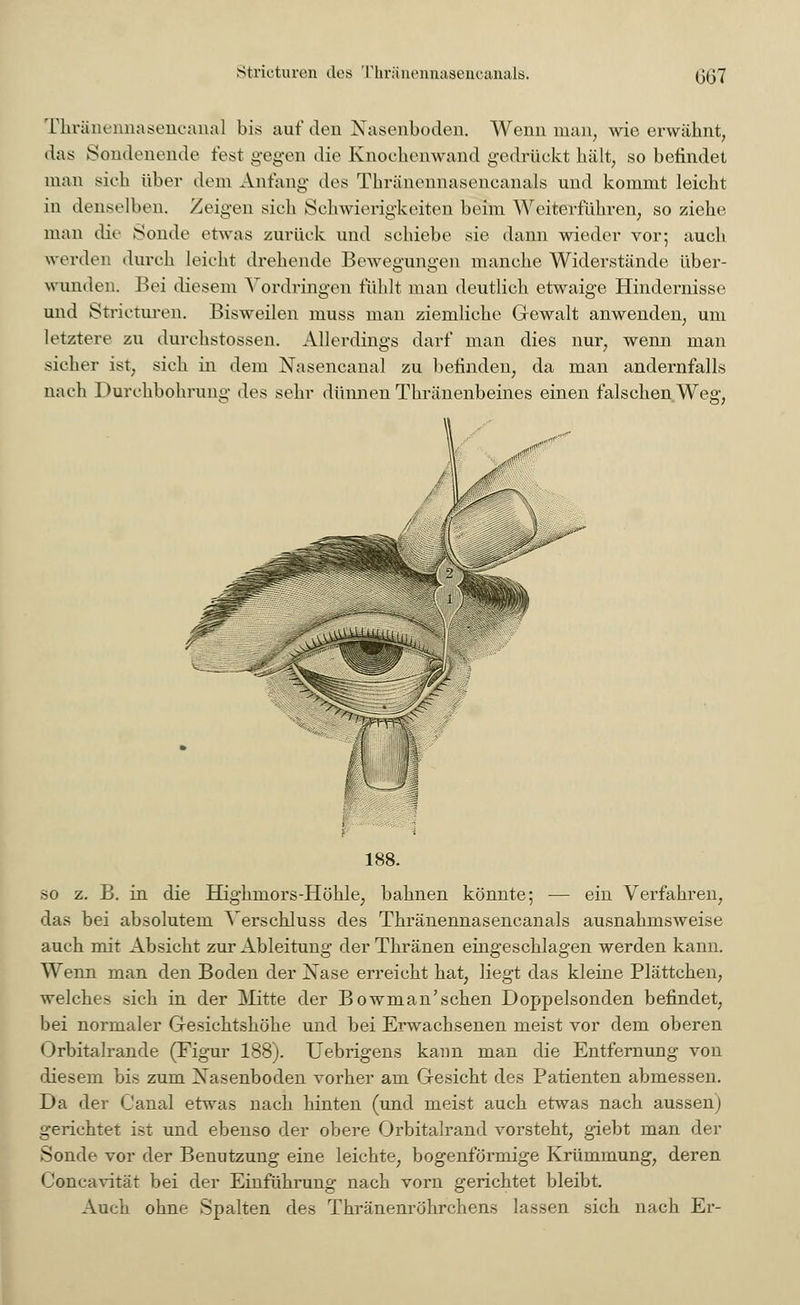 Thränennaseneanal bis auf den Nasenboden. Wenn man, wie erwähnt, das Sondenende fest gegen die Knoehemwancl gedrückt hält, so befindet man sich über dem Anfang des Thränennasencanals und kommt leicht in denselben. Zeigen sieh Schwierigkeiten beim Weiterführen, so ziehe man die Sonde etwas zurück und schiebe sie dann wieder vor; auch werden durch leicht drehende Bewegungen manche Widerstände über- wunden. Bei diesem Vordringen fühlt man deutlich etwaige Hindernisse und Stricturen. Bisweilen muss man ziemliche Gewalt anwenden, um letztere zu durchstossen. Allerdings darf man dies nur, wenn man sicher ist, sich in dem Nasencanal zu befinden, da man andernfalls nach Durchbohrung des sehr dünnen Thränenbeines einen falschen Weg, > ■■ 188. so z. B. in die Highmors-Höhle, bahnen könnte; — ein Verfahren, das bei absolutem Verschluss des Thränennasencanals ausnahmsweise auch mit Absicht zur Ableitung derThränen eingeschlagen werden kann. Wenn man den Boden der Nase erreicht hat, liegt das kleine Plättchen, welches sich in der Mitte der Bowman'schen Doppelsonden befindet, bei normaler Gesichtshöhe und bei Erwachsenen meist vor dem oberen Orbitalrande (Figur 188). Uebrigens kann man die Entfernung von diesem bis zum Nasenboden vorher am Gesicht des Patienten abmessen. Da der Canal etwas nach hinten (und meist auch etwas nach aussen) gerichtet ist und ebenso der obere Orbitalrand vorsteht, giebt man der Sonde vor der Benutzung eine leichte, bogenförmige Krümmung, deren Concavität bei der Einführung nach vorn gerichtet bleibt. Auch ohne Spalten des Thränenröhrchens lassen sich nach Er-