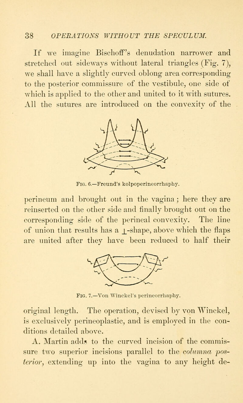 If we imagine BischofFs denudation narrower and stretched out sideways without lateral triangles (Fig. 7), we shall have a slightly curved oblong area corresponding to the posterior commissure of the vestibule, one side of which is applied to the other and united to it with sutures. All the sutures are introduced on the convexity of the Fig. 6.—Freund's kolpoperineorrhaphy. perineum and brought out in the vagina; here they are reinserted on the other side and finally brought out on the corresponding side of the perineal convexity. The line of union that results has a _[_-shape, above which the flaps are united after they have been reduced to half their Fig. 7.—Von Winckel's perineorrhaphy. original length. The operation, devised by von Winckel, is exclusively perineoplastic, and is employed in the con- ditions detailed above. A. Martin adds to the curved incision of the commis- sure two superior incisions parallel to the columna pos- terior, extending up into the vagina to any height de-