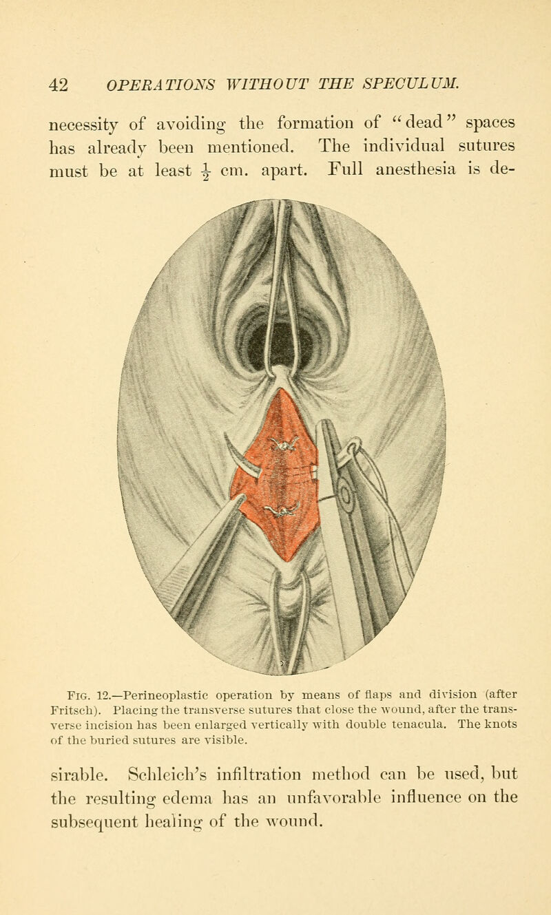 necessity of avoiding the formation of dead spaces has already been mentioned. The individual sutures must be at least \ cm. apart. Full anesthesia is de- ■■■ Fig. 12.—Perineoplastic operation by means of flaps and division (after Fritsch). Placing the transverse sutures that close the wound, after the trans- verse incision has been enlarged vertically with double tenacula. The knots of the buried sutures are visible. sirable. Schleich's infiltration method can be used, but the resulting edema has an unfavorable influence on the subsequent healing of the wound.
