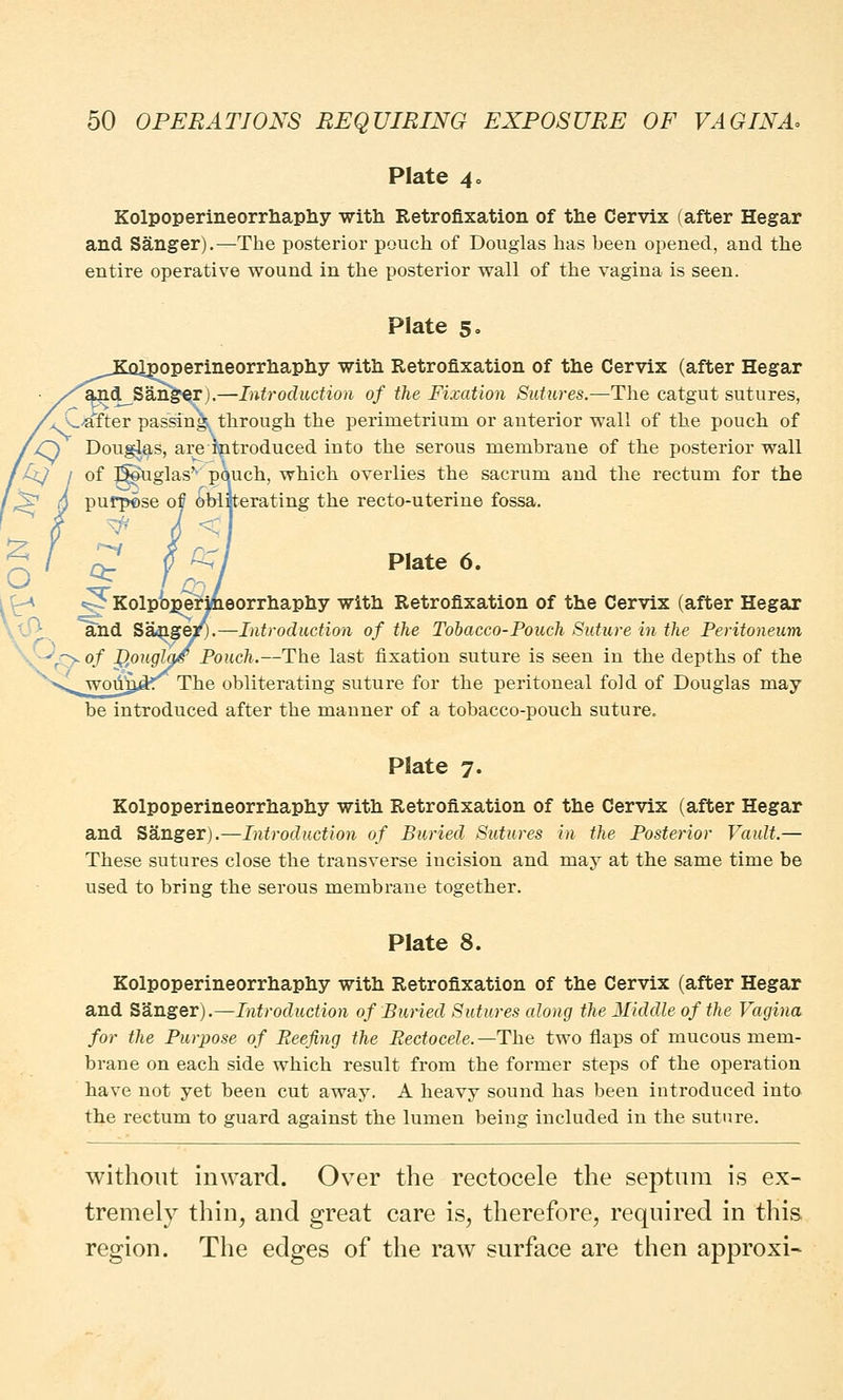 Plate 4o Kolpoperineorrhaphy -with Retrofixation of the Cervix (after Hegar and Sanger).—The posterior pouch of Douglas has heen opened, and the entire operative wound in the posterior wall of the vagina is seen. Plate 5. ^perineorrhaphy with Retrofixation of the Cervix (after Hegar 'and^Sangerj.—Introduction of the Fixation Sutures.—The catgut sutures, A_-after passing, through the perimetrium or anterior wall of the pouch of Doug-las, are-introduced [n^0 the serous membrane of the posterior wall of J^uglasv pouch, which overlies the sacrum and the rectum for the purpose of obliterating the recto-uterine fossa. £? 0 r<l Plate 6. ?Kolpop^riineorrhaphy with Retrofixation of the Cervix (after Hegar and Sange/).—Introduction of the Tobacco-Pouch Suture in the Peritoneum of P/ouglg/ Pouch.—Tbe last fixation suture is seen in the depths of the The obliterating suture for the peritoneal fold of Douglas may be introduced after the manner of a tobacco-pouch suture. Plate 7. Kolpoperineorrhaphy with Retrofixation of the Cervix (after Hegar and Sanger).—Introduction of Buried Sutures in the Posterior Vault.— These sutures close the transverse incision and may at the same time be used to bring the serous membrane together. Plate 8. Kolpoperineorrhaphy with Retrofixation of the Cervix (after Hegar and Sanger).—Introduction of Buried Sutures along the Middle of the Vagina for the Purpose of Reefing the Rectocele. —The two flaps of mucous mem- brane on each side which result from the former steps of the operation have not yet been cut away. A heavy sound has been introduced into the rectum to guard against the lumen being included in the suture. without inward. Over the rectocele the septum is ex- tremely thin, and great care is, therefore, required in this region. The edges of the raw surface are then approxi-