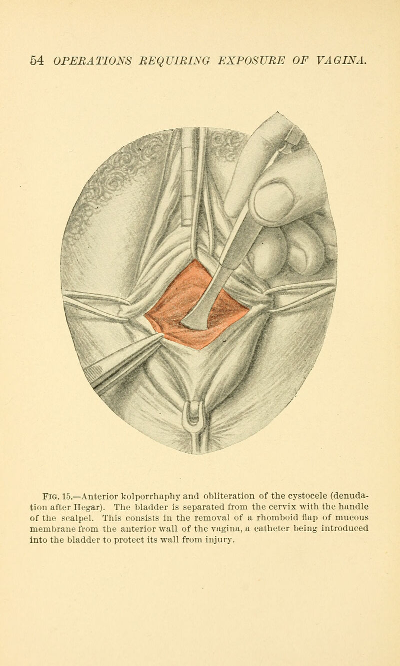 X- i. Fig. 15.—Anterior kolporrhaphy and obliteration of the cystocele (denuda- tion after Hegar). The bladder is separated from the cervix with the handle of the scalpel. This consists in the removal of a rhomboid flap of mucous membrane from the anterior wall of the vagina, a catheter being introduced into the bladder to protect its wall from injury.
