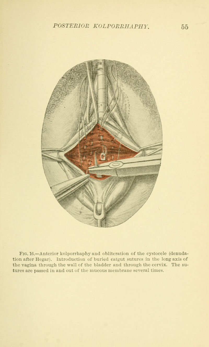 Fig. 16.—Anterior kolporrhaphy and obliteration of the cystocele (denuda- tion after Hegar). Introduction of buried catgut sutures in the long axis of the vagina through the wall of the bladder and through the cervix. The su- tures are passed in and out of the mucous membrane several times.