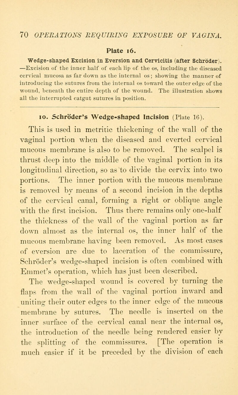 Plate i6. Wedge-shaped Excision in Eversion and Cervicitis (after Schroder). —Excision of the inner half of each lip of the os, including the diseased cervical mucosa as far down as the internal os; showing the manner of introducing the sutures from the internal os toward the outer edge of the wound, heneath the entire depth of the wound. The illustration shows all the interrupted catgut sutures in position. 10. Schroder's Wedge-shaped Incision (Plate 16). This is used in metritic thickening of the wall of the vaginal portion when the diseased and everted cervical mucous membrane is also to be removed. The scalpel is thrust deep into the middle of the vaginal portion in its longitudinal direction, so asvto divide the cervix into two portions. The inner portion with the mucous membrane is removed by means of a second incision in the depths of the cervical canal, forming a right or oblique angle with the first incision. Thus there remains only one-half the thickness of the wall of the vaginal portion as far down almost as the internal os, the inner half of the mucous membrane having been removed. As most cases of eversion are due to laceration of the commissure, Schroder's wedge-shaped incision is often combined with Emmet's operation, which has just been described. The wedge-shaped wound is covered by turning the flaps from the wall of the vaginal portion inward and uniting their outer edges to the inner edge of the mucous membrane by sutures. The needle is inserted on the inner surface of the cervical canal near the internal os, the introduction of the needle being rendered easier by the splitting of the commissures. [The operation is much easier if it be preceded by the division of each