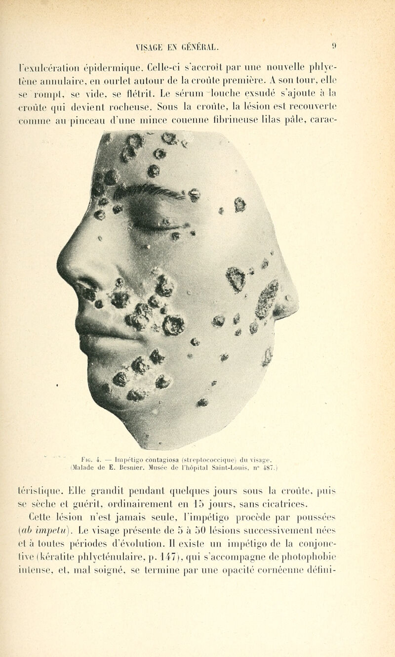 lexuk'éi'alion épidermique. Celle-ci s'accroît par une nouvelle phlyc- tène annulaire, en ourlet autour de la croûte première. A son tour, elle se rompt, se vide, se flétrit. Le sérum touche exsudé s'ajoute à la croûte qui devient rocheuse. Sous la croûte, la lésion est recouverte comme au pinceau d'une mince couenne tibrineuse lilas pâle, carac- FiG. i. — Iin])r'tiy(i contagiosa (slre]itococciqiie) du visage. iMalade de E. Desnier. Jlusée de l'hôpital Saint-Louis, n° iS7.) téristique. Elle grandit pendant quelques jours sous la croûte, puis se sèche et guérit, ordinairement en 15 jours, sans cicatrices. Cette lésion n'est jamais seule, limpétigo procède par poussées {ab impetu). Le visage présente de 5 à 50 lésions successivement nées et à toutes périodes d'évolution. Il existe un impétigo de la conjonc- tive (kératite phlycténulaire, p. 147), qui s'accompagne de photopliobie intense, et, mal soigné, se termine par une opacité cornéenne détini-