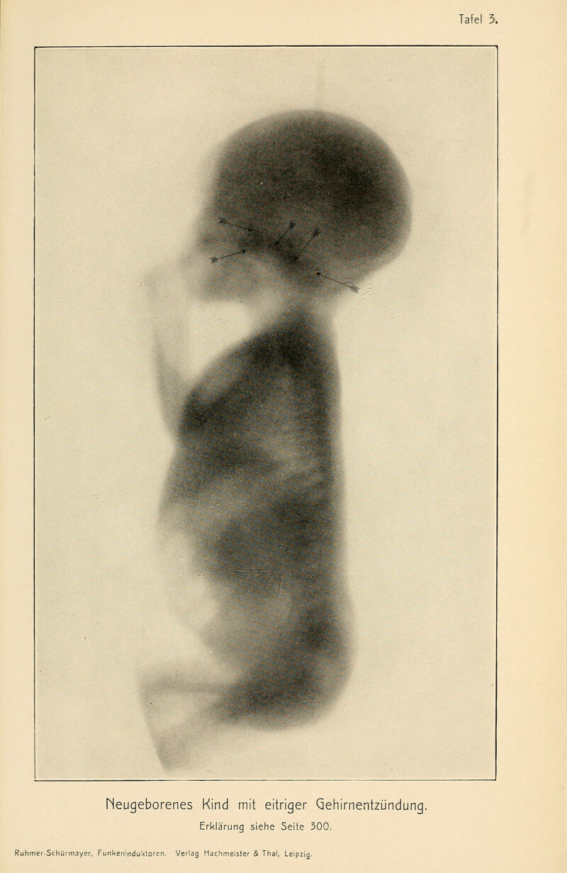 heugeborenes Kind mit eitriger Gehirnentzündung. Erklärung siehe Seite 300,